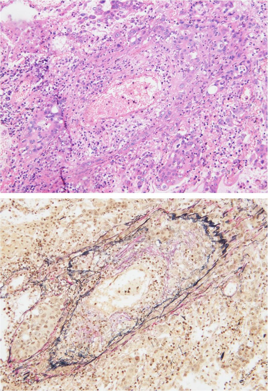 Shinozki et l. BMC Cncer (2018) 18:620 Pge 4 of 5 tumor emolism ws oserved in the right lung (Fig. 6, ). This ws recorded s the cuse of deth sed on the utopsy.