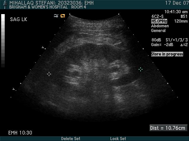 These renal sonograms are from a 25 yo woman with!