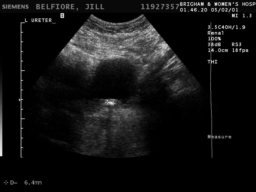 This is an image obtained through the bladder trigone! slightly to the left of midline.