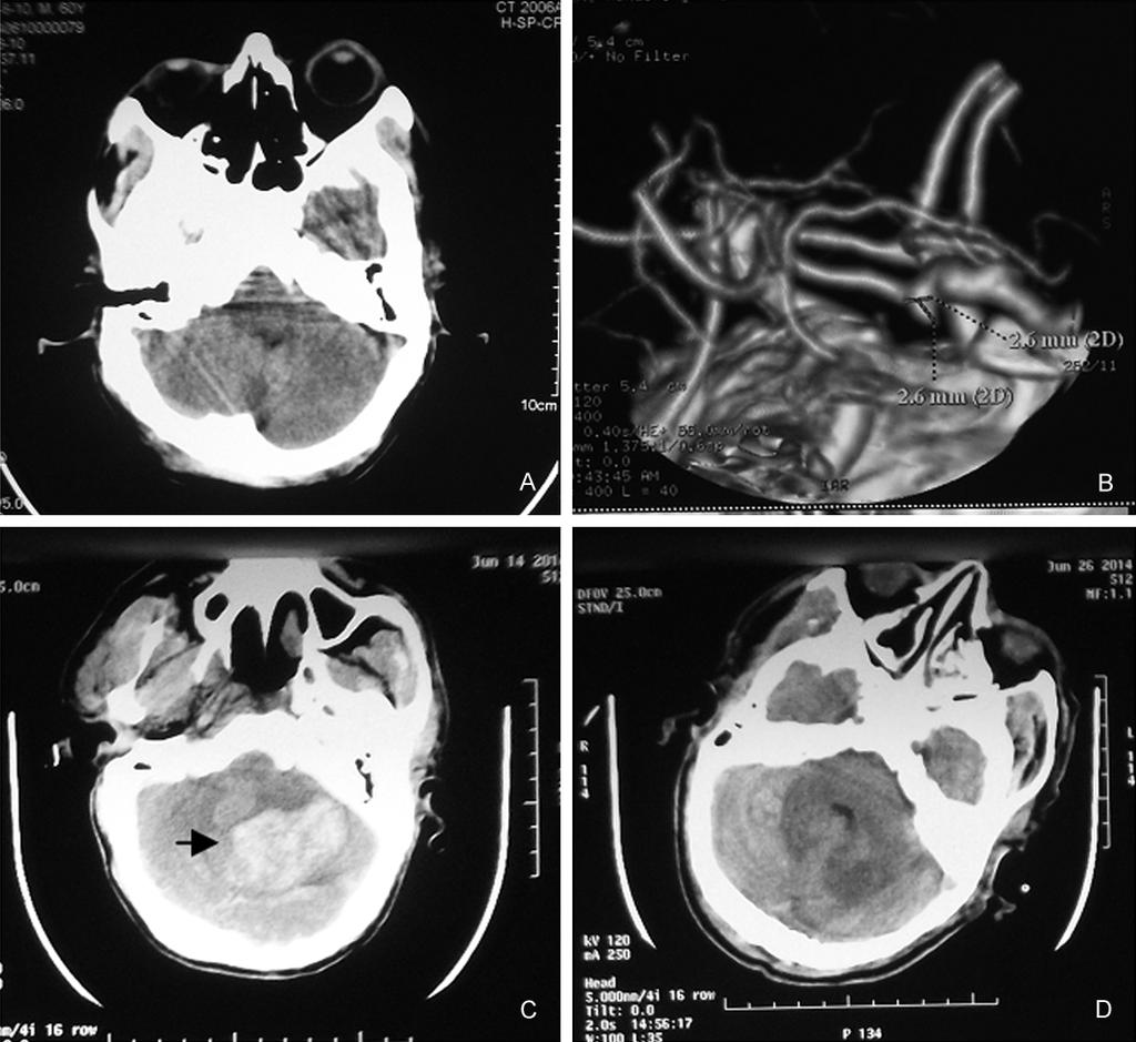 Figure 1. Patient 1. A. Before microsurgical clipping of intracranial aneurysms, no cerebellar hemorrhage was present on skull CT scan; B.