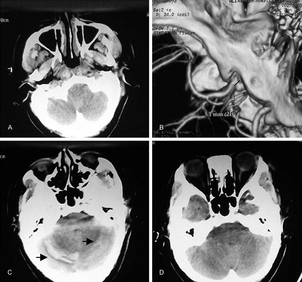 Figure 2. Patient 2. A. Before microsurgical clipping of intracranial aneurysms, no cerebellar hemorrhage was present on skull CT scan; B.