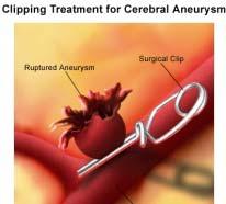 Clip vs coil : Aneurysm location Posterior circulation aneurysms: higher complication rate with microsurgical treatment, most undergo endovascular therapy. Raaymakers TW, Rinkel GJ, et al.