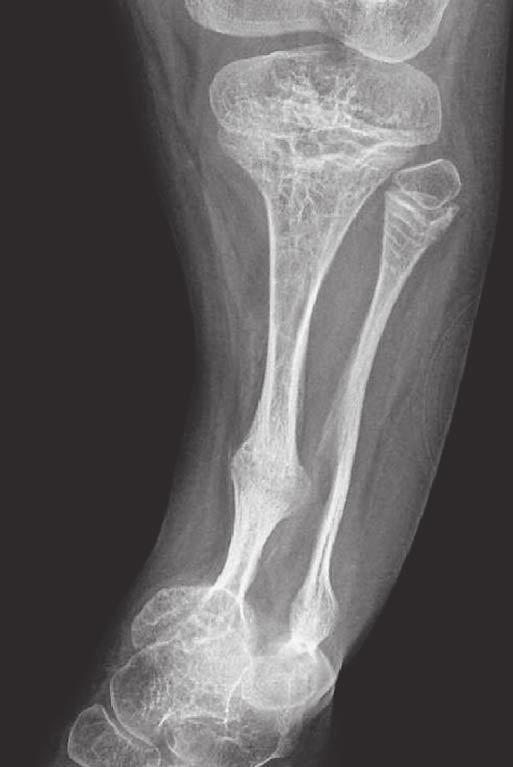 parallel to the growth plate; they are located in the metaphysis and move towards the diaphysis in step with bone growth.