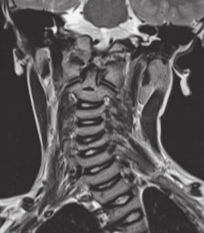 Severe platyspondyly with vertebral compression fractures and codfish vertebrae are more common in this type of OI than in other types (Figure 7, 8).