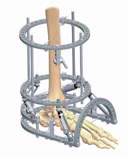 2 COMPONENTS REQUIRED COMPONENTS REQUIRED ANKLE ARTHRODESIS - RECOMMENDED COMPONENTS Component Part Number Quantity Full Ring (Size dependent) 2 Foot Plate (Size dependent) 2 Foot Plate Extension