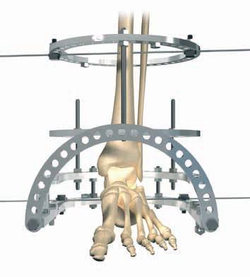 What follows is one of many techniques which may be used to successfully affix the TrueLok Ankle Arthrodesis Frame to the limb.