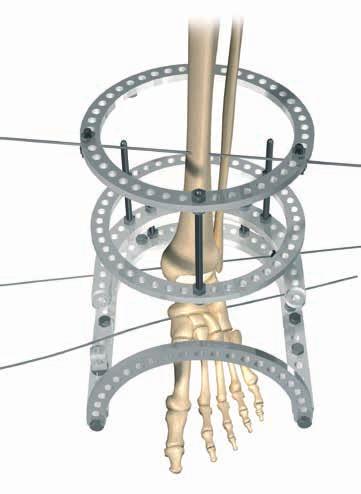 INSERT FOURTH WIRE Insert a medial face wire (4) at the proximal tibial ring level to complete stabilization of the proximal