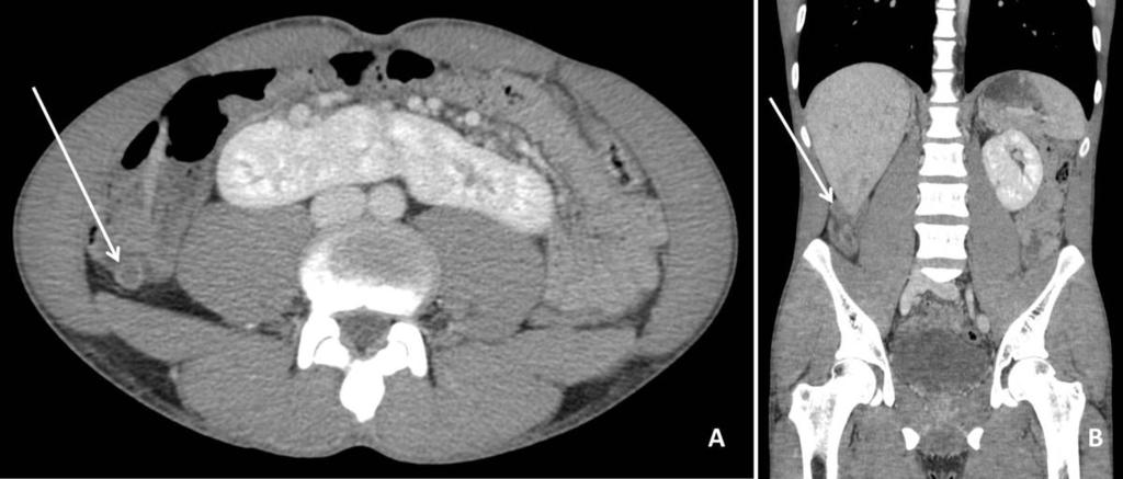 2: Axial (A) and coronal (B) images from an IV-contrast enhanced CTAP that demonstrate dilatation and mucosal enhancement of the appendix with surrounding fat stranding (arrow).