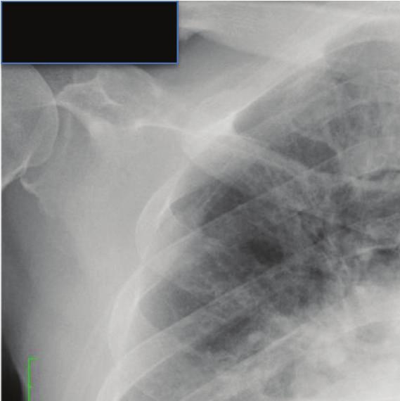 2 Case Reports in Cardiology Chest X-Ray. Significant pulmonary congestion and reduced bilateral lung permeability due to pleural effusion were seen (cardiothoracic rate of 65%) (Figure 1).