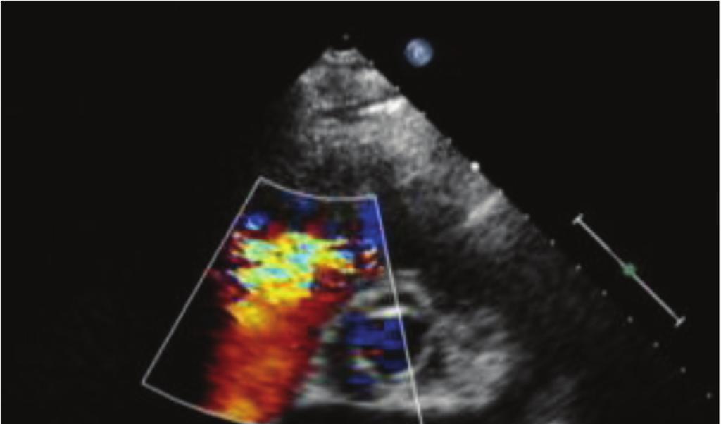 Case Reports in Cardiology 3 (a) (b) Figure 2: Echocardiography: short axis (a) and apical 4-chamber (b) view.