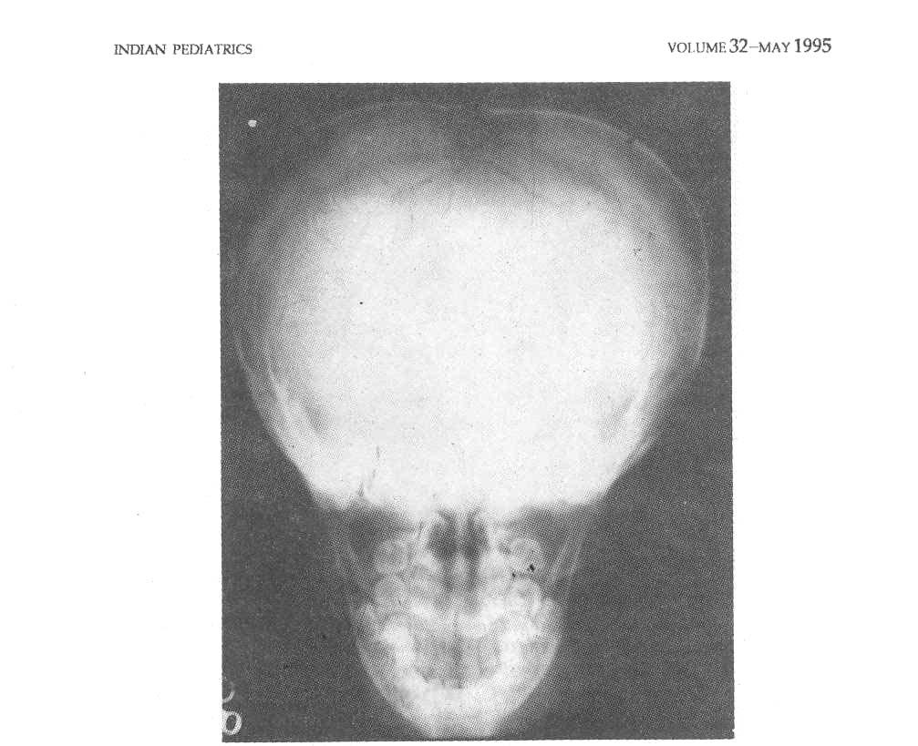 Fig. 3. X-ray skull (lateral) showing widely open sutures and wormian bones perhaps an under reported entity(2).