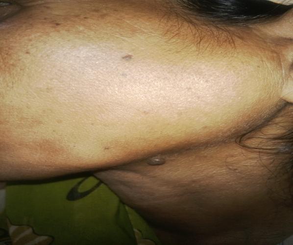 Fig 1: Clinical photograph showing diffuse swelling in left mandibular region.