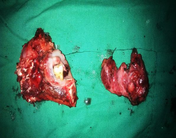 Fig-3: Specimen photograph showing tumor resected by left segmental