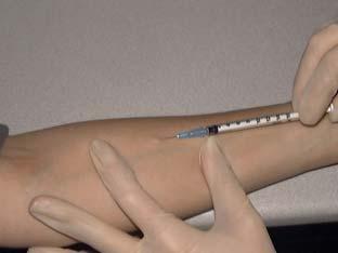 surface of forearm using a 27-gauge needle Produce a wheal 6 to