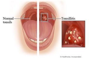 TONSILLITIS Viral infection of the tonsils Symptoms include swollen and red tonsils