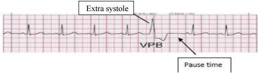 1. Premature ventricular contraction (PVC) or ventricular extra systole: There s one extra systole in the ventricles + it is only one point to give you the extra systole.