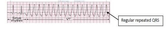 Bigeminal: one normal beat coming from the SA node, followed up by an abnormal beat from the ventricle. So one normal, one abnormal (repeat). 3.