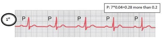 The most common complication of arrhythmia is Heart failure, and the most dangerous complication is atrial fibrillation (because the heart rate is very high shallow atrial contraction blood will stay