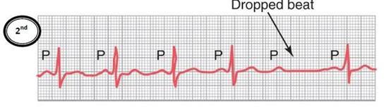 In the last figure the distance between P and R was almost 7 small squares more than 5 1 st degree heart block.