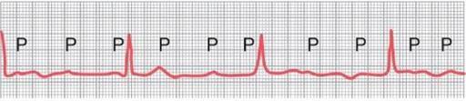 PR wave is normal, then slightly increases till one beat is missing.