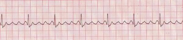3) Atrial flutter: The rate in the focus is more than 220; (250-300). But the point here is that this rate will cross to the ventricle regularly. So, atrial flutter happens in regular case. (R.E.G.U.