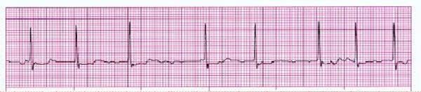 Related ECGs: P is repeated in different frequencies (irregular) {abnormal ECG} in atrial