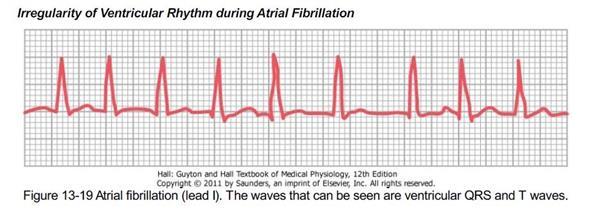 In atrial fibrillation, the P wave will be very shallow and sometime absent, you can see too many