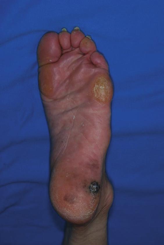 2 Case Reports in Oncological Medicine Figure 1: The findings of primary skin tumor when first diagnosed. The lesion was 55 40 mm in size with a 15 mm-diameter nonulcerated nodule in the center.