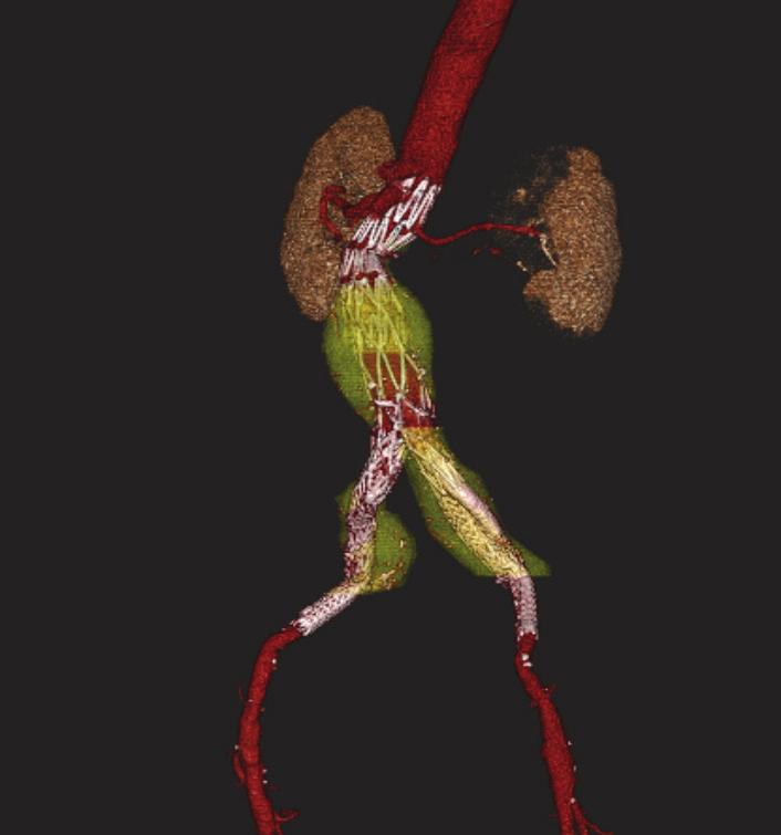 EVAR WITH EMBOLIZATION Historically, interventional occlusion of the HA has commonly been applied in patients undergoing EVAR, especially when the aneurysmal process extends to one or both of the