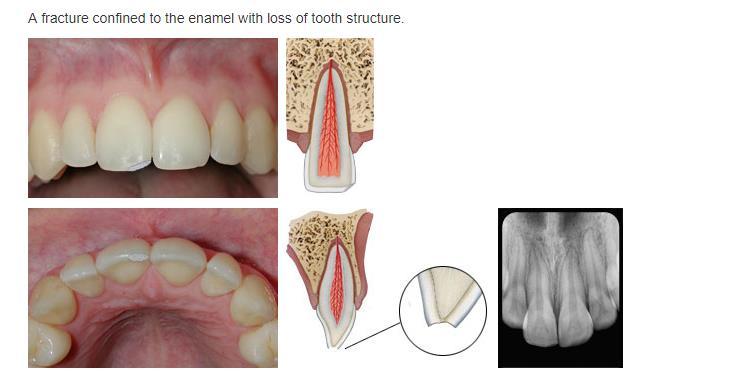 ENAMEL FRACTURES Little to no pain or sensitivity Fairly easy fix