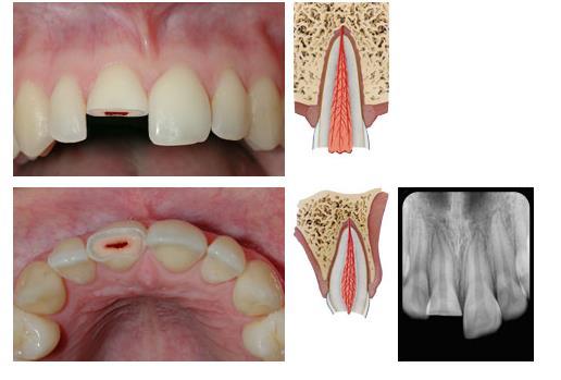ENAMEL-DENTIN-PULP FRACTURES In most cases, sensitivity to air/cold or pain Restoration at the dentist must include