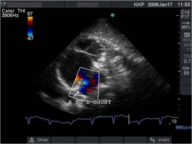 Fig.4 Subcostal view showing right to left shunt through a patent foramen ovale Sometimes a contrast echo with 10ml of agitated saline may be needed to demonstrate the right to left shunt.