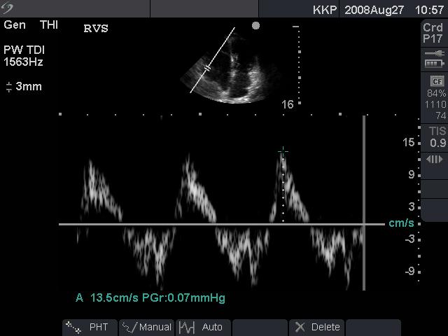 Fig.6 Tricuspid annulus peak systolic velocity Assessment of Pulmonary Arterial pressures Systolic pressure The presence of at least a trivial tricuspid regurgitant jet is almost universal.