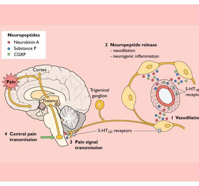 Migraine (1970 s and 80 s) Trigeminovascular Theory Trigeminovascular