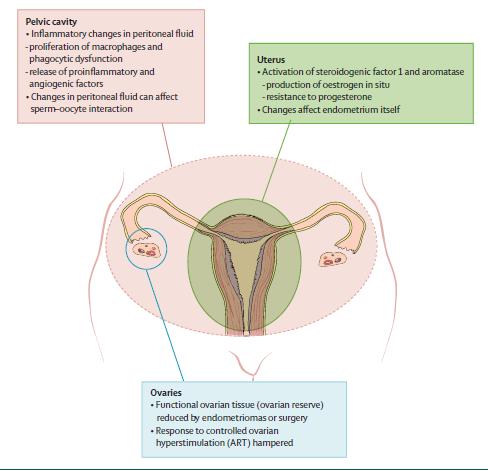 Possible Mechanisms Distorted Pelvic Anatomy Altered Hormonal and Cellmediated Function Altered Peritoneal