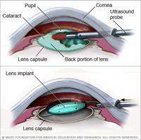 Standard Cataract Surgery: Phacoemulsification Laser-assisted Cataract Surgery (LACS) Intraoperative OCT Photodisruption: air bubbles FDA approved