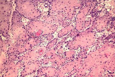 H&N Cancer) Histological appearance of necrosis in Oral Squamous Cell Carcinoma