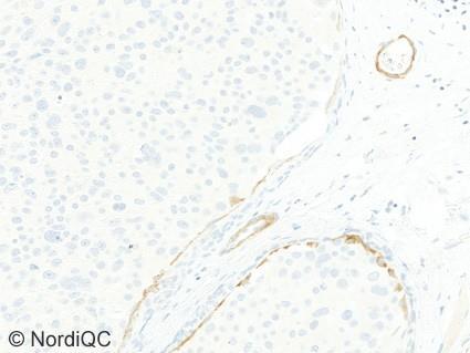 A moderate, distinct and continuous staining reaction is seen in the myoepithelial cells lining the breast DCIS