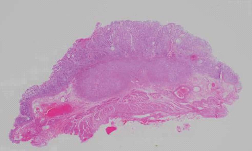 The specimen was positive for vascular and lymphatic involvement. Mucin special stain results for the resected stomach specimen were MUC1 positive, MUC2 negative, MUC5AC positive, and MUC6 negative.