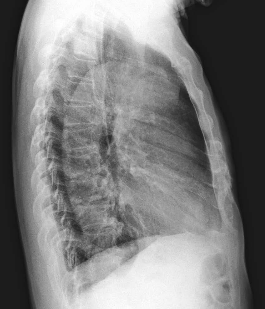 portion of left upper lung zone (arrow) is visible on chest PA.