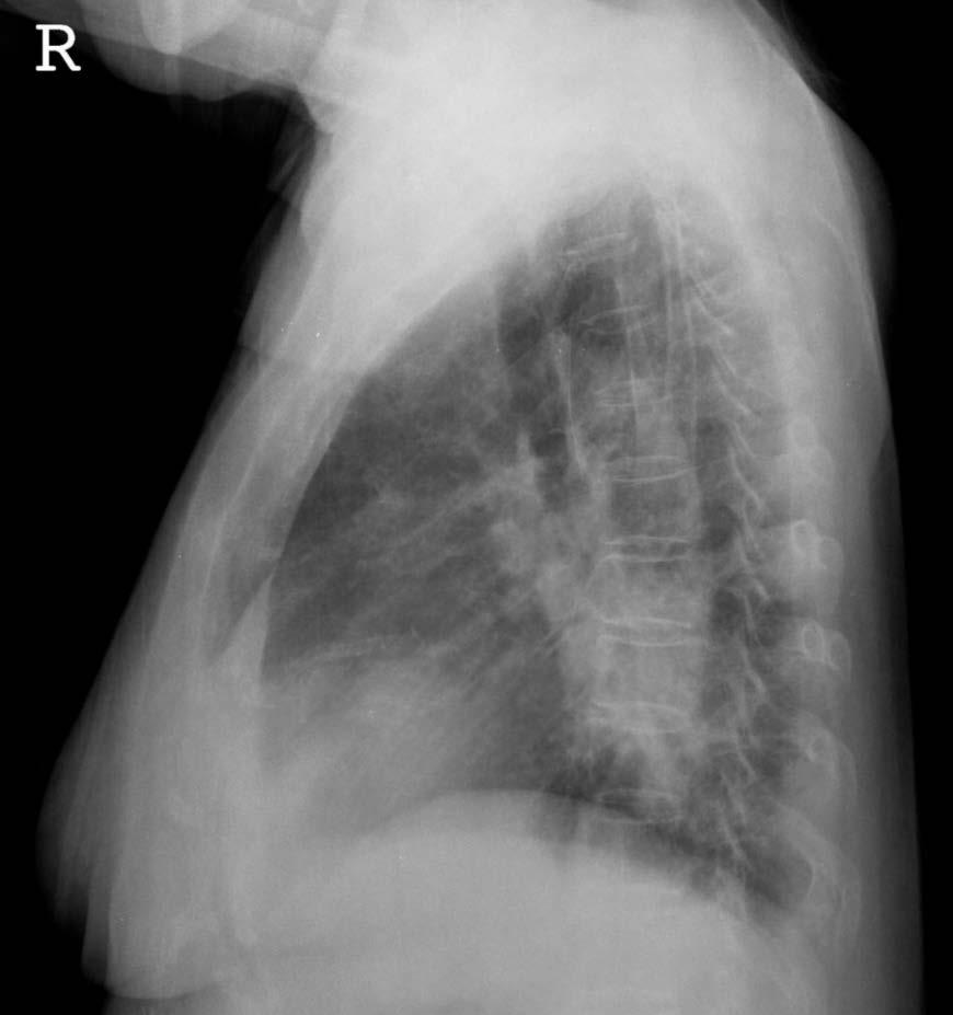 opacities in left lower lung zone (arrow) is a suspicious finding, the overlapped breast shadow make difficult to diagnose.