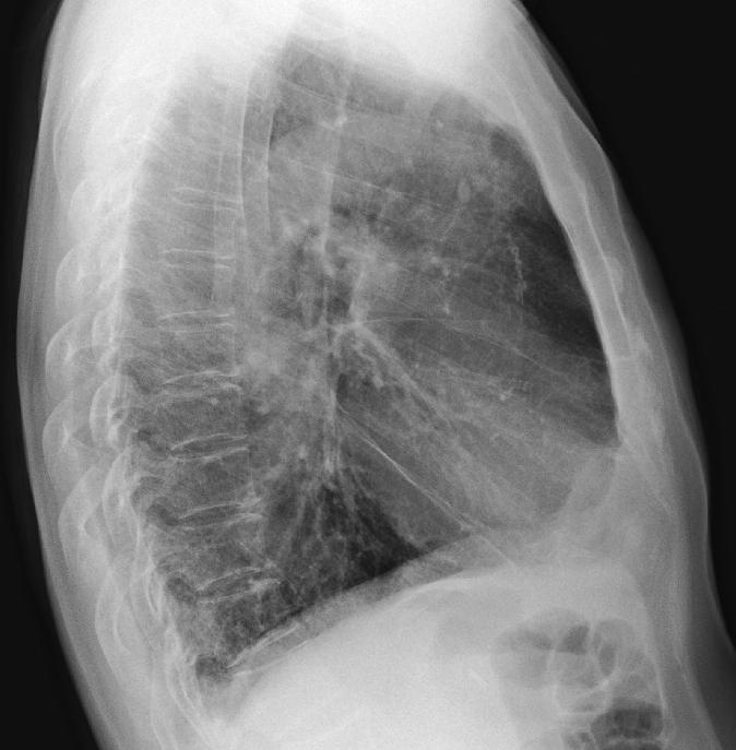 increased opacity is visible in medial portion of right middle lung zone (arrow).
