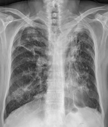 On initial chest PA (red box), ill-defined increased opacities