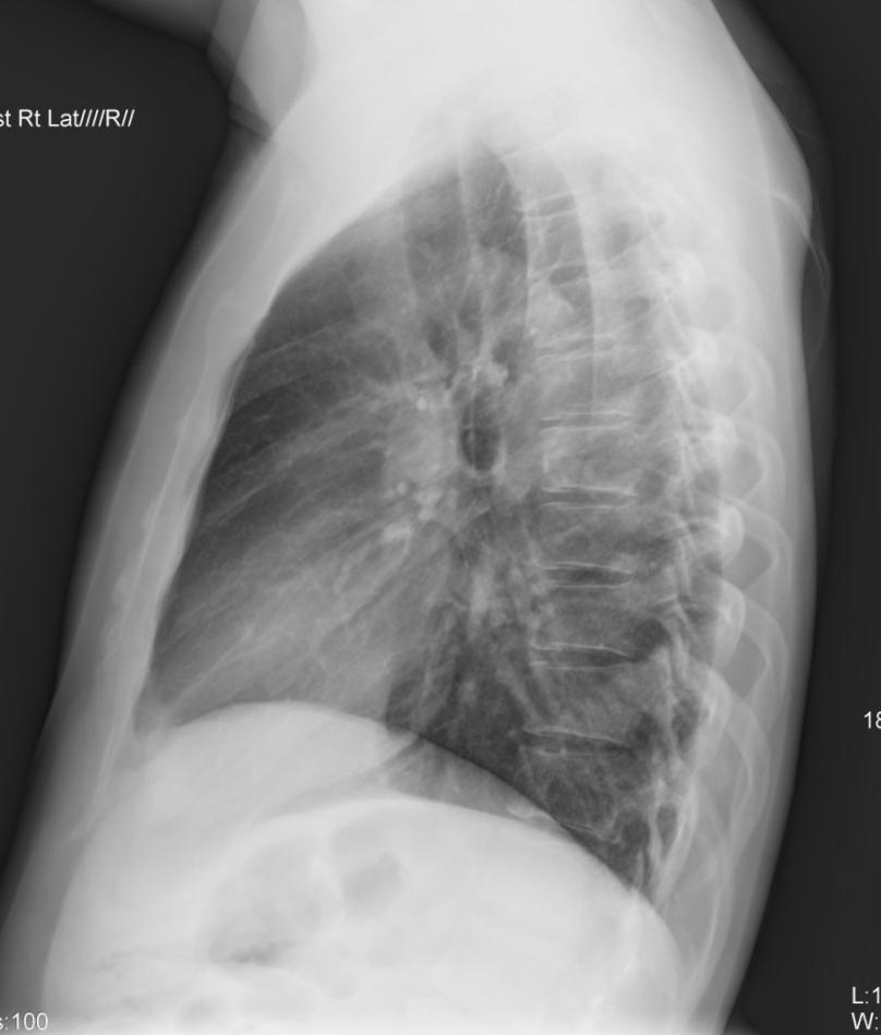 Normal Lateral plain radiograph Distance
