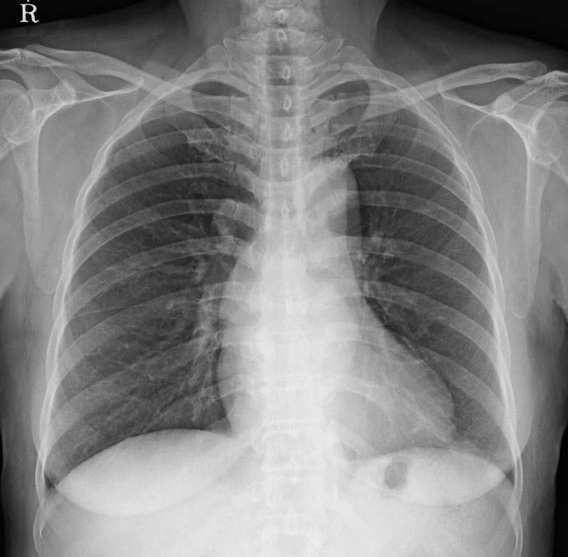 during routine follow up chest PA/lateral Faint right suprahilar increased opacity (arrow)