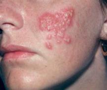 Viruses cause chicken pox, warts, and cold sores. Infects epidermal cells, overgrowth and itching.