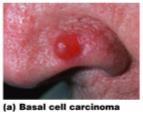 Skin Cancer Basal cell carcinoma affects cells in the stratum basale.
