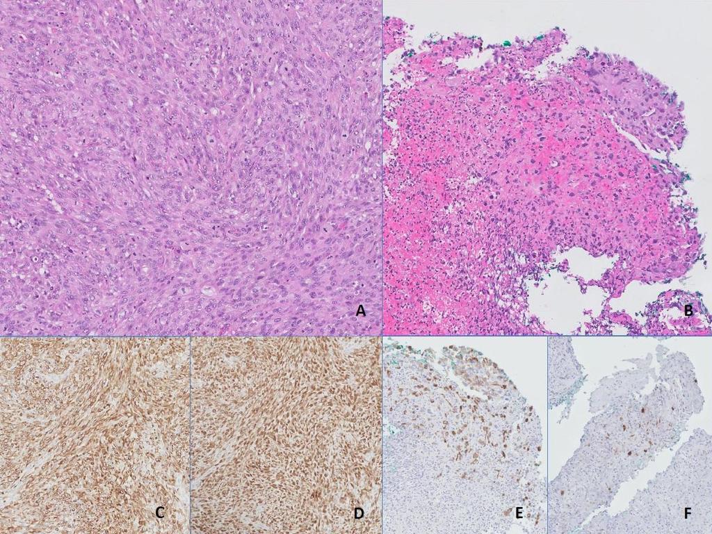 Lin JYJ et al. American Journals of Cancer Case Reports 2014, 3:1-5 Page 3 of 5 Case Report A 71-year-old Chinese gentleman presented 12 months ago with hematuria.