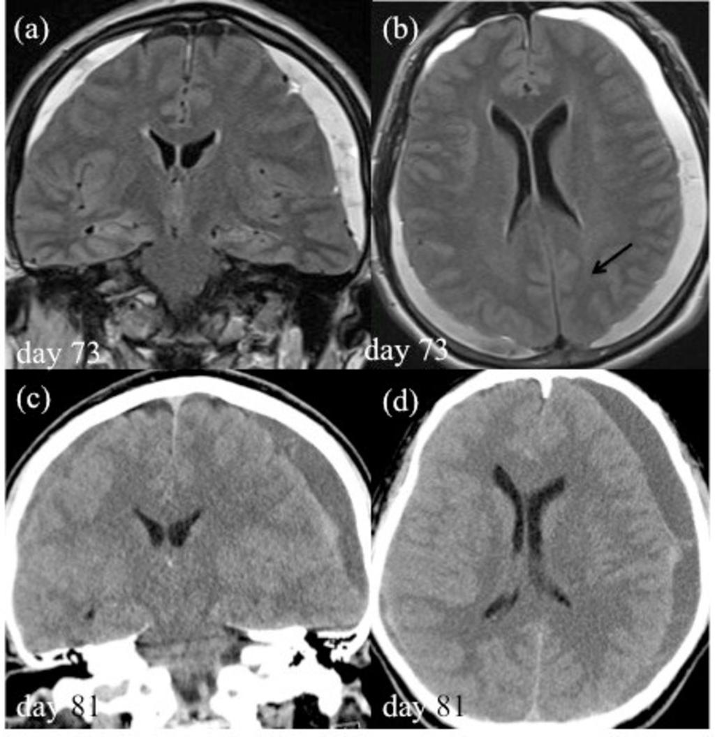 Fig. 2: Large SDH with SIH (a, b)flair, (c, d)ct CT shows chronic bilateral subdural hematoma
