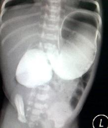 Whirlpool sign in midgut volvulus Differential Diagnosis List Annular pancreas, Duodenal atresia Figures Figure 1